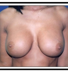 After – Breast Augmentation