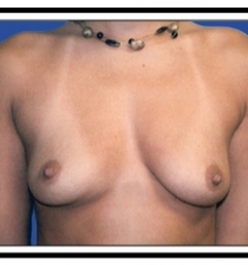 Before – Breast Augmentation