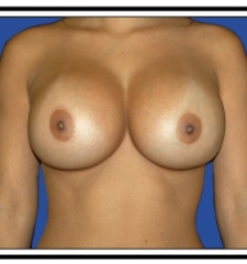 After – Breast Augmentation
