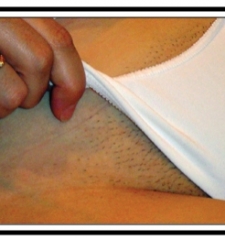 Before - Laser Hair Removal