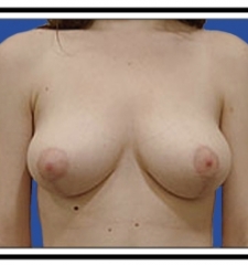 After – Breast Reduction