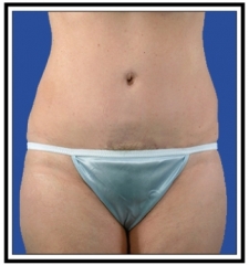 After – Tummy Tuck