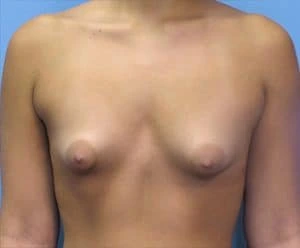 breast enlargement new jersey before