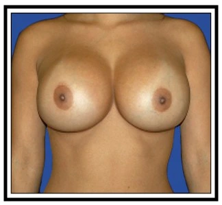 breast enlargement nj after