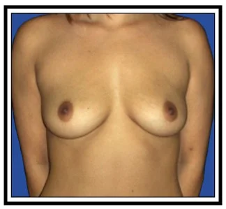 breast enlargement nj before