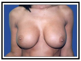 breast enlargement paramus nj after