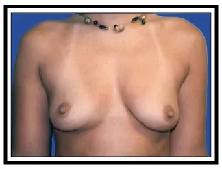 breast enlargement paramus nj before
