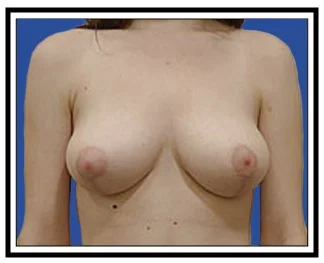 breast reduction nj after