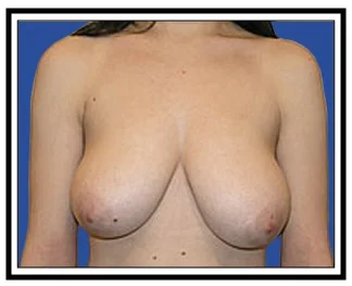 breast reduction nj before