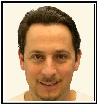hair transplant paramus new jersey after