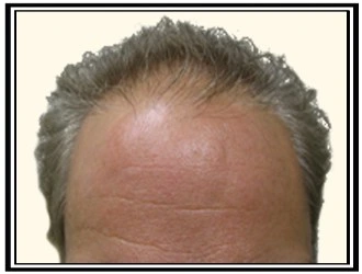 hair transplant patient before