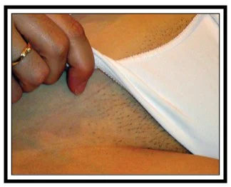 laser hair removal nj before