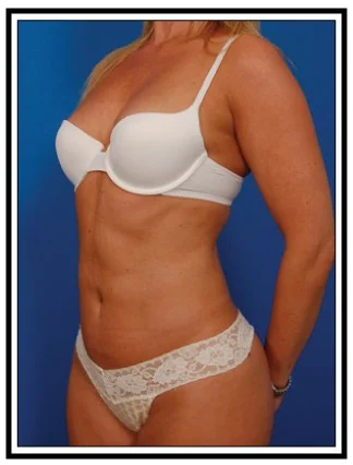 liposuction after