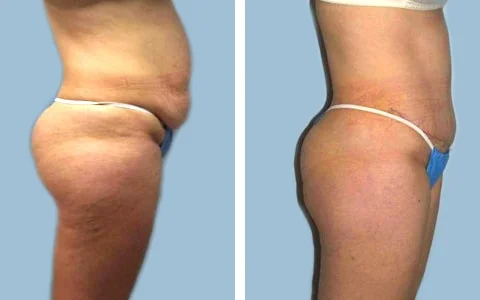 liposuction before after nj