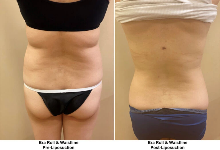 liposuction nj before after