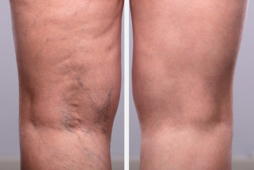 new jersey vein care