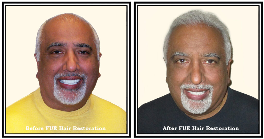 before after hair transplant paramus NJ